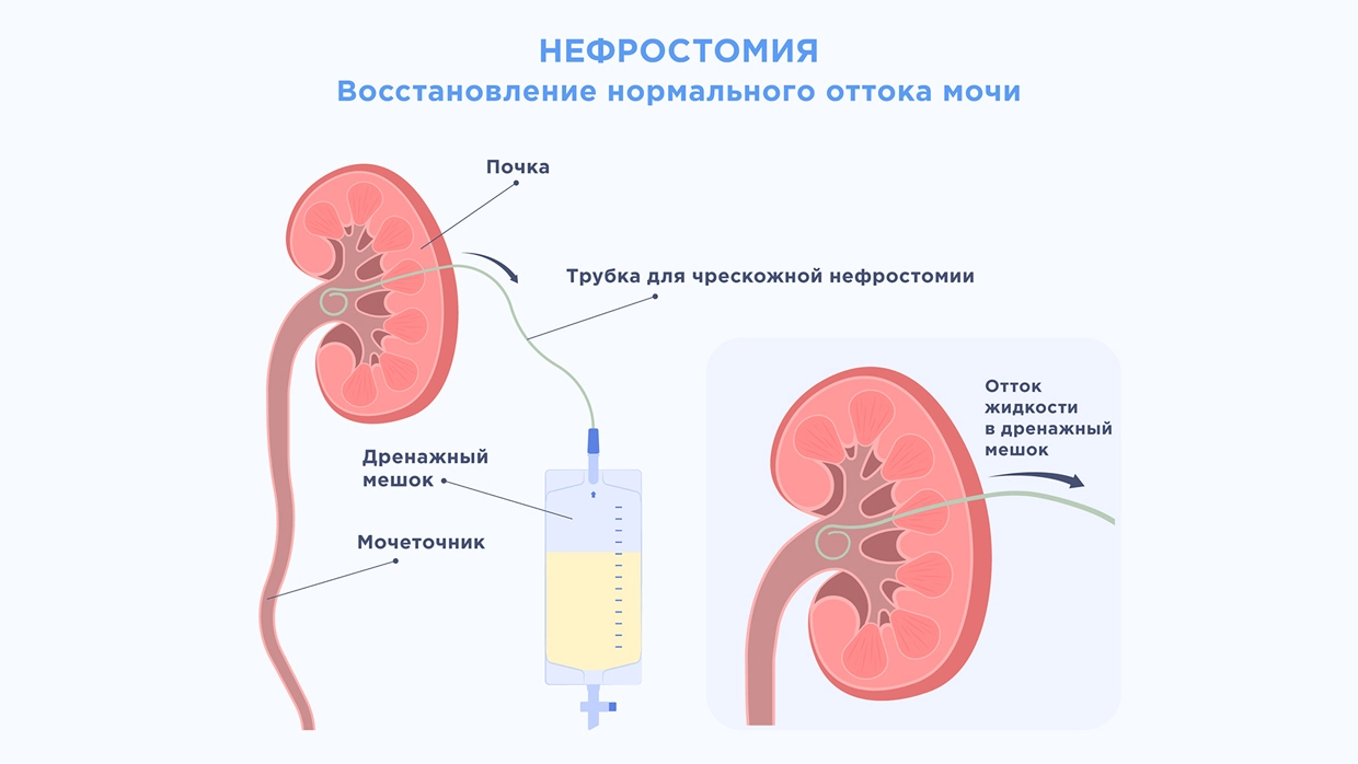 Гидронефротическая трансформация почки ~ Гидронефроз